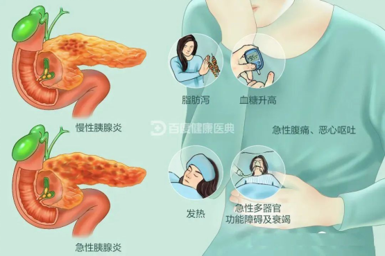 【健康科普】饮食不当，当心会要命的急性胰腺炎208.png